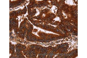 Immunohistochemistry of Human gastric cancer using GCKR Polyclonal Antibody at dilution of 1:50 (GCKR 抗体)