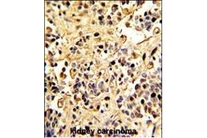 Formalin-fixed and paraffin-embedded human kidney carcinoma with Neprilysin Antibody (C-term), which was peroxidase-conjugated to the secondary antibody, followed by DAB staining. (MME 抗体  (C-Term))