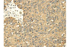 The image on the left is immunohistochemistry of paraffin-embedded Human breast cancer tissue using ABIN7128021(SRPRB Antibody) at dilution 1/30, on the right is treated with fusion protein. (SRPRB 抗体)