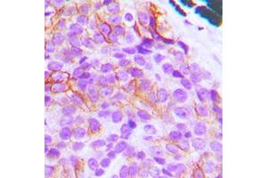 Immunohistochemical analysis of BIM staining in human breast cancer formalin fixed paraffin embedded tissue section. (BIM 抗体  (N-Term))
