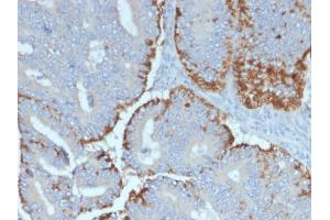 Formalin-fixed, paraffin-embedded human Colon Carcinoma stained with ATG5 Mouse Monoclonal Antibody (ATG5/2492). (ATG5 抗体  (AA 1-119))