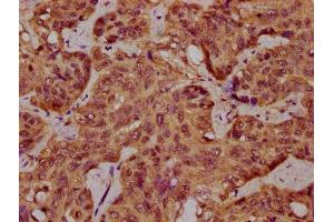 IHC image of ABIN7168937 diluted at 1:400 and staining in paraffin-embedded human liver cancer performed on a Leica BondTM system. (SPINK9 抗体  (AA 20-86))