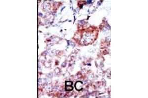 Formalin-fixed and paraffin-embedded human cancer tissue reacted with the primary antibody, which was peroxidase-conjugated to the secondary antibody, followed by AEC staining. (ILK 抗体  (N-Term))