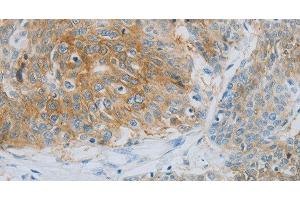 Immunohistochemistry of paraffin-embedded Human esophagus cancer using NDRG1 Polyclonal Antibody at dilution of 1:70 (NDRG1 抗体)