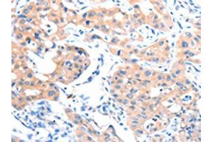 The image on the left is immunohistochemistry of paraffin-embedded Human lung cancer tissue using ABIN7128186(ACSM5 Antibody) at dilution 1/35, on the right is treated with fusion protein. (ACSM5 抗体)