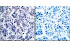 Immunohistochemistry analysis of paraffin-embedded human breast carcinoma tissue, using TYK2 (Ab-1054) Antibody. (TYK2 抗体  (AA 1020-1069))
