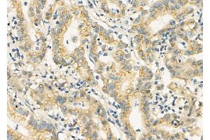 ABIN6258794 and ABIN6275896 at 1/100 staining Human colorectal cancer by IHC-P. (FAM3D 抗体  (C-Term))