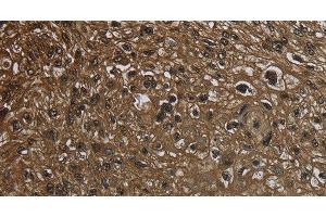 Immunohistochemistry of paraffin-embedded Human esophagus cancer using GLO1 Polyclonal Antibody at dilution of 1:50 (GLO1 抗体)