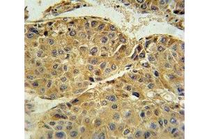 Beta III Tubulin antibody immunohistochemistry analysis in formalin fixed and paraffin embedded human hepatocarcinoma. (TUBB3 抗体  (AA 36-63))