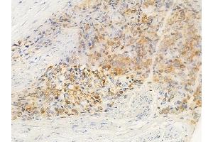 ABIN6262739 and ABIN6266625 at 1/100 staining human prostate carcinoma by IHC-P.