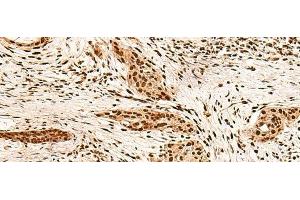 Immunohistochemistry of paraffin-embedded Human esophagus cancer tissue using PAFAH1B2 Polyclonal Antibody at dilution of 1:60(x200)