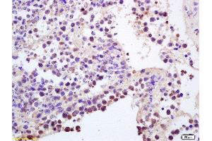 Formalin-fixed and paraffin embedded mouse intestine carcinoma labeled with Anti-CCR5/CD195 Polyclonal Antibody, Unconjugated  at 1:200, followed by conjugation to the secondary antibody and DAB staining (CCR5 抗体  (AA 201-300))
