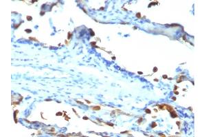 Formalin-fixed, paraffin-embedded human Lung Carcinoma stained with Milk Fat Globule Monoclonal Antibody (EDM45) (MFGE8 抗体)