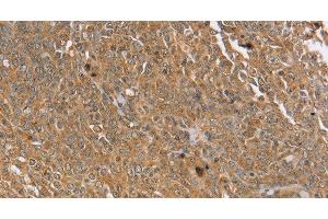 Immunohistochemistry of paraffin-embedded Human cervical cancer using PTPN20 Polyclonal Antibody at dilution of 1:30 (PTPN20 抗体)
