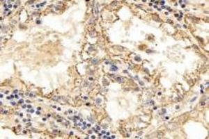 Immunohistochemistry analysis of paraffin-embedded human kidney cancer using TPPP3 (ABIN7076047) at dilution of 1: 3000 (TPPP3 抗体)