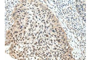 The image on the left is immunohistochemistry of paraffin-embedded Human esophagus cancer tissue using ABIN7191723(NSD1 Antibody) at dilution 1/25, on the right is treated with synthetic peptide. (NSD1 抗体)