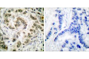 Peptide - +Immunohistochemical analysis of paraffin-embedded human lung carcinoma tissue usingantibody (#C0178). (E2F4 抗体)