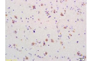 Formalin-fixed and paraffin embedded human brain glioblastoma labeled Anti-PDCD4 Polyclonal Antibody, Unconjugated (ABIN731993) at 1:200, followed by conjugation to the secondary antibody and DAB staining (PDCD4 抗体  (AA 1-100))