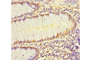 Immunohistochemistry of paraffin-embedded human colon cancer using ABIN7158401 at dilution of 1:100 (L1TD1 抗体  (AA 665-865))
