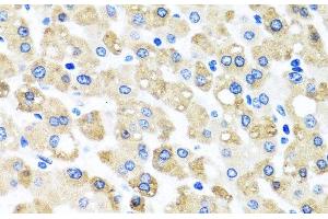 Immunohistochemistry of paraffin-embedded Human liver damage using SNAP29 Polyclonal Antibody at dilution of 1:100 (40x lens). (SNAP29 抗体)
