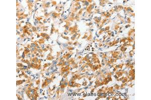 Immunohistochemistry of Human liver cancer using ANAPC2 Polyclonal Antibody at dilution of 1:30 (ANAPC2 抗体)