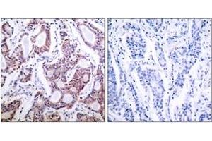 Immunohistochemistry analysis of paraffin-embedded human breast carcinoma tissue, using NF-kappaB p100/p52 (Ab-869) Antibody. (NFKB2 抗体  (AA 836-885))