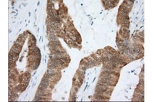 Immunohistochemical staining of paraffin-embedded Human liver tissue using anti-ACAT2 mouse monoclonal antibody. (ACAT2 抗体)