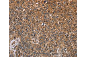 Immunohistochemistry of Human lung cancer using GH2 Polyclonal Antibody at dilution of 1:40 (Growth Hormone 2 抗体)