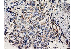 Immunohistochemical staining of paraffin-embedded Carcinoma of Human lung tissue using anti-NDEL1 mouse monoclonal antibody. (NDEL1 抗体)