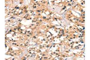 The image on the left is immunohistochemistry of paraffin-embedded Human thyroid cancer tissue using ABIN7129096(CUEDC2 Antibody) at dilution 1/30, on the right is treated with fusion protein. (CUEDC2 抗体)