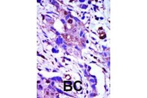 Formalin-fixed and paraffin-embedded human cancer tissue reacted with the primary antibody, which was peroxidase-conjugated to the secondary antibody, followed by AEC staining. (PLK1 抗体  (C-Term))
