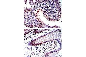 Immunohistochemical analysis of paraffin-embedded human intima cancer tissue (A) and colon tissue (B) using PSMB8 monoclonal antobody, clone 1A5  with DAB staining. (PSMB8 抗体)