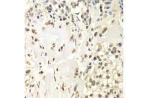 Immunohistochemistry of paraffin-embedded human kidney cancer using USP7 antibody (ABIN6293331) at dilution of 1:200 (40x lens). (USP7 抗体)