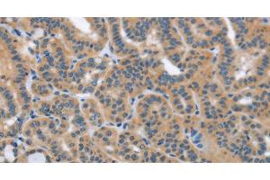 Immunohistochemistry of paraffin-embedded Human thyroid cancer using HSD3B1 Polyclonal Antibody at dilution of 1:40 (HSD3B1 抗体)