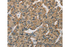 Immunohistochemistry of Human liver cancer using CTSE Polyclonal Antibody at dilution of 1:50 (Cathepsin E 抗体)