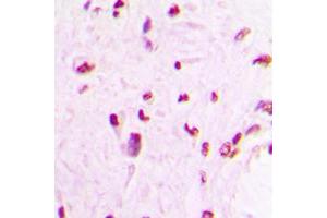 Immunohistochemical analysis of MEF2C staining in human lung cancer formalin fixed paraffin embedded tissue section. (MEF2C 抗体  (C-Term))