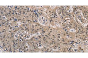Immunohistochemistry of paraffin-embedded Human gastric cancer using DPYSL3 Polyclonal Antibody at dilution of 1:30 (DPYSL3 抗体)