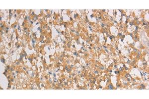 Immunohistochemistry of paraffin-embedded Human thyroid cancer tissue using ART3 Polyclonal Antibody at dilution 1:40 (ART3 抗体)
