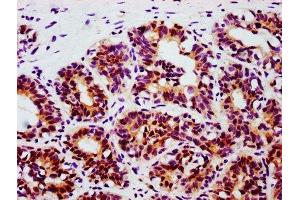 Immunohistochemistry (IHC) image for anti-Signal Transducer and Activator of Transcription 3 (Acute-Phase Response Factor) (STAT3) (pTyr705) antibody (ABIN7127755)