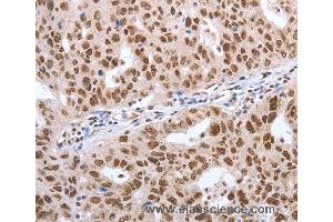 Immunohistochemistry of Human lung cancer using POU3F1 Polyclonal Antibody at dilution of 1:40