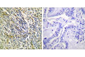 Cl-Peptide - +Immunohistochemical analysis of paraffin-embedded human lung carcinoma tissue using Aggrecan (Cleaved-Asp369) antibody (#L0101). (Aggrecan 抗体  (Cleaved-Asp369))