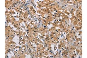 The image on the left is immunohistochemistry of paraffin-embedded Human thyroid cancer tissue using ABIN7129183(DDX43 Antibody) at dilution 1/50, on the right is treated with fusion protein. (DDX43 抗体)