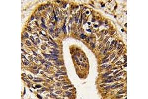 IHC analysis of FFPE human prostate carcinoma tissue stained with anti-HER2 antibody (ErbB2/Her2 抗体  (AA 1227-1255))