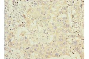 Immunohistochemistry of paraffin-embedded human liver cancer using ABIN7155913 at dilution of 1:100 (HCFC1R1 抗体  (AA 1-119))