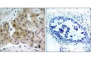 Immunohistochemistry analysis of paraffin-embedded human breast carcinoma, using VEGFR2 (Phospho-Tyr1175) Antibody. (VEGFR2/CD309 抗体  (pTyr1175))