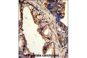 Formalin-fixed and paraffin-embedded human prostate carcinoma with TGM4 Antibody (Center), which was peroxidase-conjugated to the secondary antibody, followed by DAB staining. (TGM4 抗体  (AA 135-164))