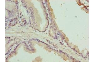 Immunohistochemistry of paraffin-embedded human prostate cancer using ABIN7174755 at dilution of 1:100 (C17orf64 抗体  (AA 111-236))