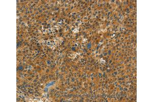 Immunohistochemistry of Human thyroid cancer using NPAP1 Polyclonal Antibody at dilution of 1:60 (NPAP1 抗体)