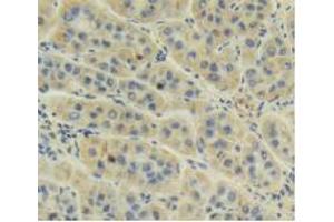 IHC-P analysis of Human Liver Cancer Tissue, with DAB staining. (AMH 抗体  (AA 453-560))