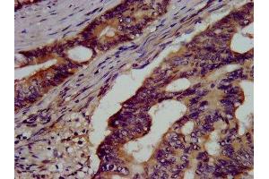IHC image of ABIN7154126 diluted at 1:500 and staining in paraffin-embedded human colon cancer performed on a Leica BondTM system. (Glutathione Synthetase 抗体  (AA 290-418))